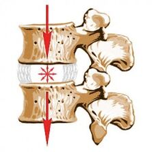 Zařízení páteře a příčiny osteochondózy