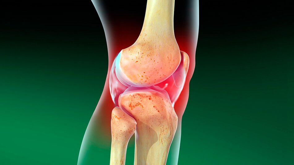 Osteoartróza kolenního kloubu